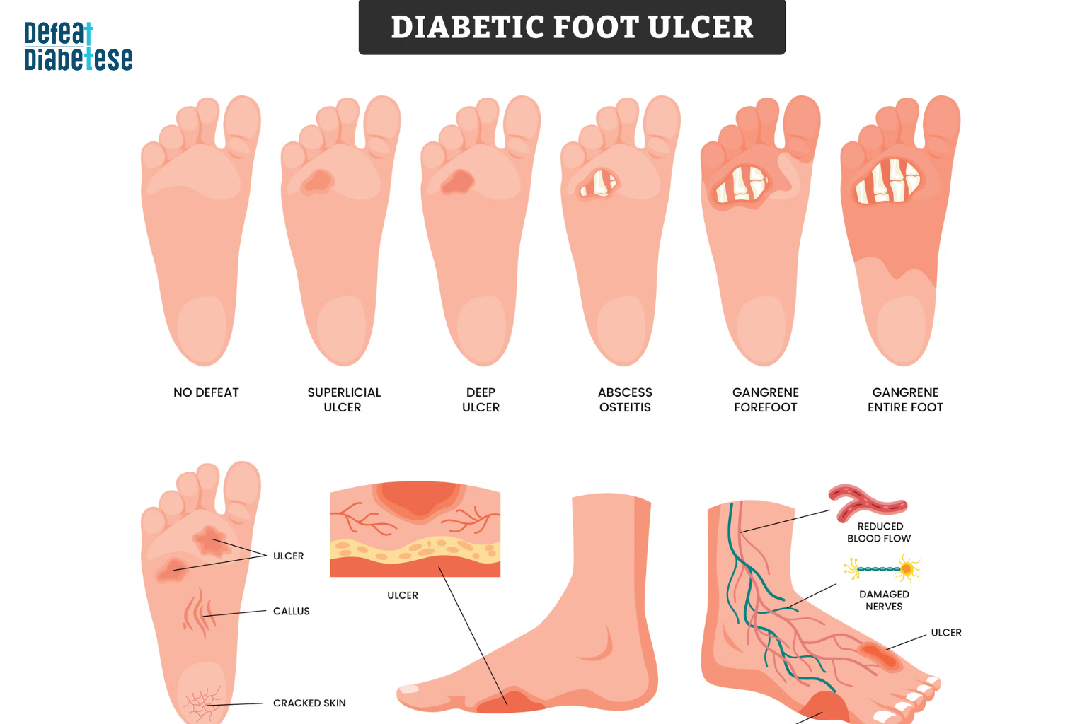 Understanding diabetic foot ulcers: Learn the stages from minor cracks and superficial ulcers to severe gangrene. Early detection, regular foot care, and monitoring blood flow and nerve health are essential to prevent complications in diabetes. Stay proactive about diabetic foot health.